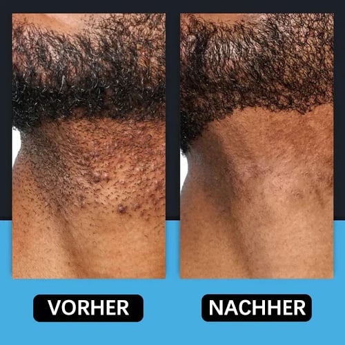 🔥🍃 Glättende Lösung zur Behandlung eingewachsener Haare