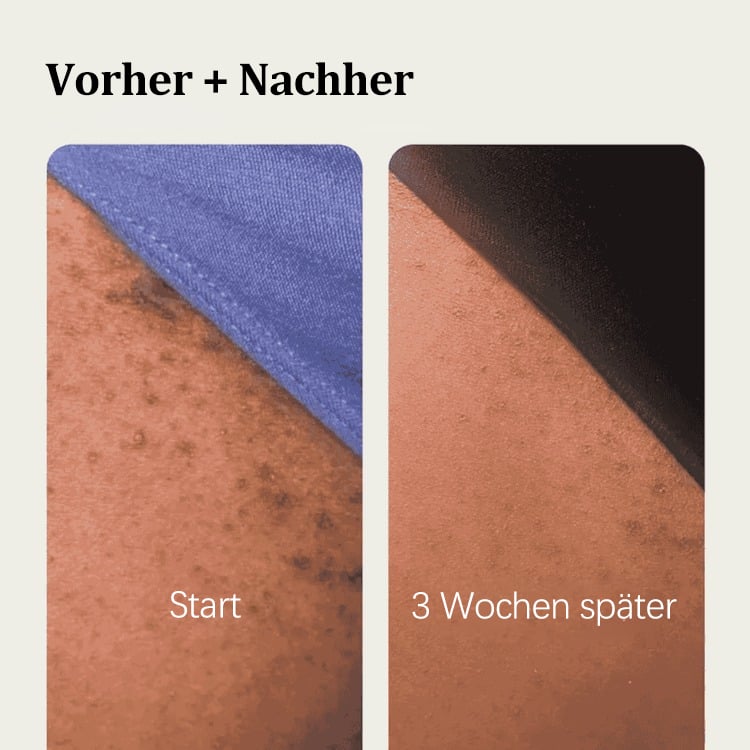 🔥🍃 Glättende Lösung zur Behandlung eingewachsener Haare